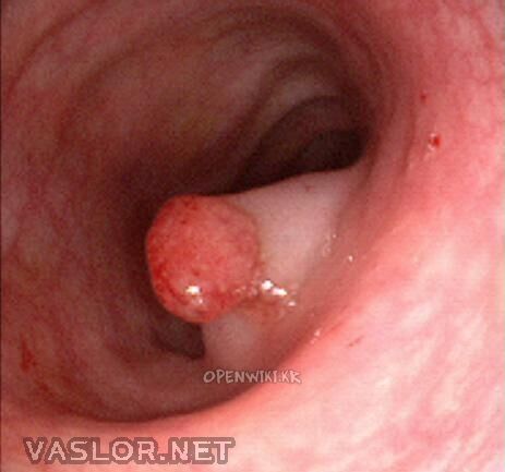 adenomatous_polyp.jpg