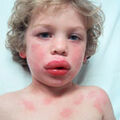 allergy.jpg