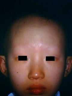 alopecia6-30.jpg