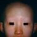 alopecia6-302.jpg