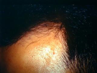 alopeciaandrogenic9-317.jpg