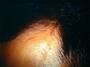 med:alopeciaandrogenic9-317.jpg