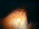 med:alopeciaandrogenic9-3172.jpg