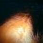 alopeciaandrogenic9-3172.jpg