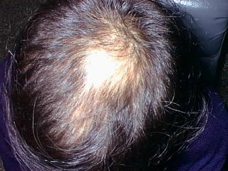 alopeciamale1.jpg
