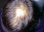 med:alopeciamale1.jpg