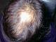 med:alopeciamale12.jpg