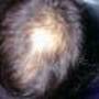alopeciamale12.jpg