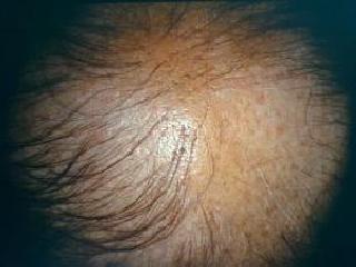 alopeciamale3.jpg