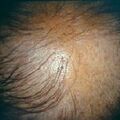 alopeciamale3.jpg