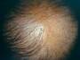 med:alopeciamale3.jpg