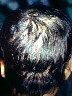 alopeciatotalis23.jpg