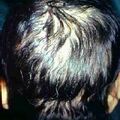 alopeciatotalis23.jpg