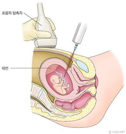 amniocentesis_0915124413.png