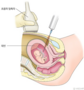 med:amniocentesis_0915124413.png