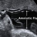 amniotic_fluid.jpg