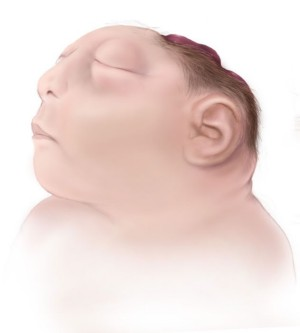 anencephaly-160750.png