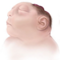 anencephaly-160750.png