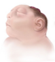 med:anencephaly-160750.png