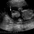 anencephaly.jpg