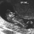 anencephaly_2.jpg