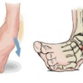 ankle_sprain-115749.png
