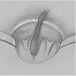 anoderm-cushion_sparing_hemorrhoidectomy01.jpg