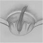 anoderm-cushion_sparing_hemorrhoidectomy01.jpg
