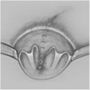 anoderm-cushion_sparing_hemorrhoidectomy02.jpg