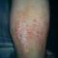 atopicdermatitis8-2982.jpg