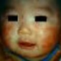 atopicdermatitis8-8052.jpg