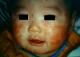 atopicdermatitis8-8052.jpg