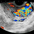 av-malformation.jpg