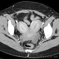 bicornuate_uterus.jpg