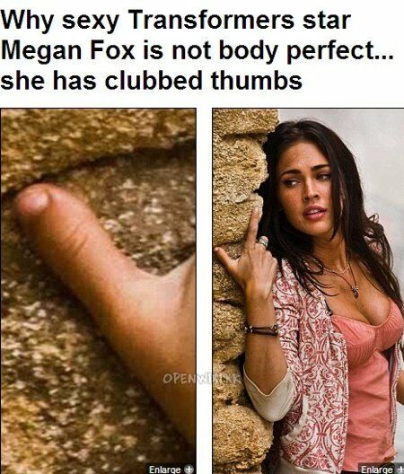 brachydactyly.jpg