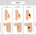 breast_cancer_3251.png