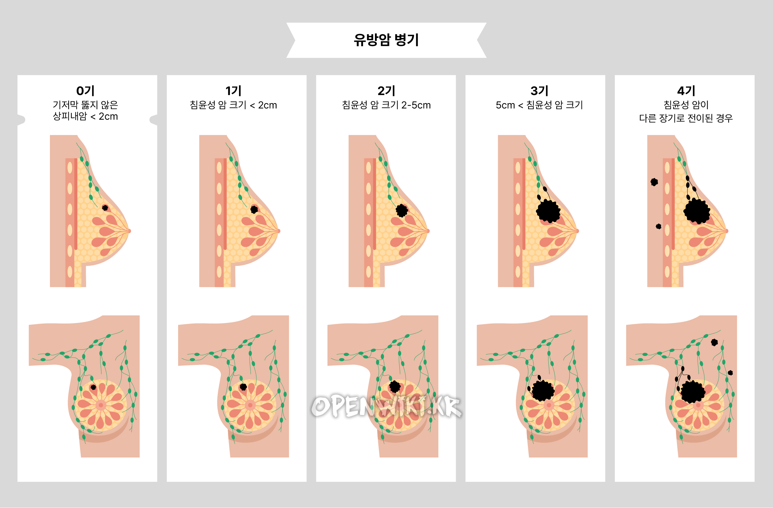 breast_cancer_3251.png