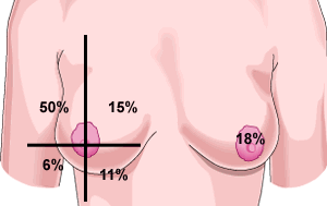 breast_cancer_quadrant.gif