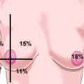 breast_cancer_quadrant.gif