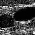 breast_cyst_ultrasound_2a.jpg