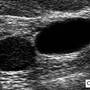 breast_cyst_ultrasound_2a.jpg