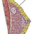 breast_fibroadenoma.jpg