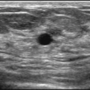 breast_sonography_0916182920.png