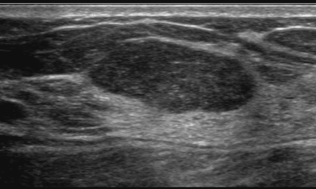 breast_sonography_0916182933.png