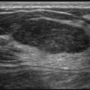 breast_sonography_0916182933.png