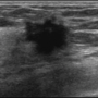 breast_sonography_0916182946.png