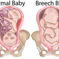 breech-baby.jpg