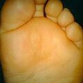 callus9-352.jpg