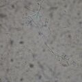 candidabalanitis010321-2.jpg