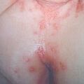 candidiasis1.jpg